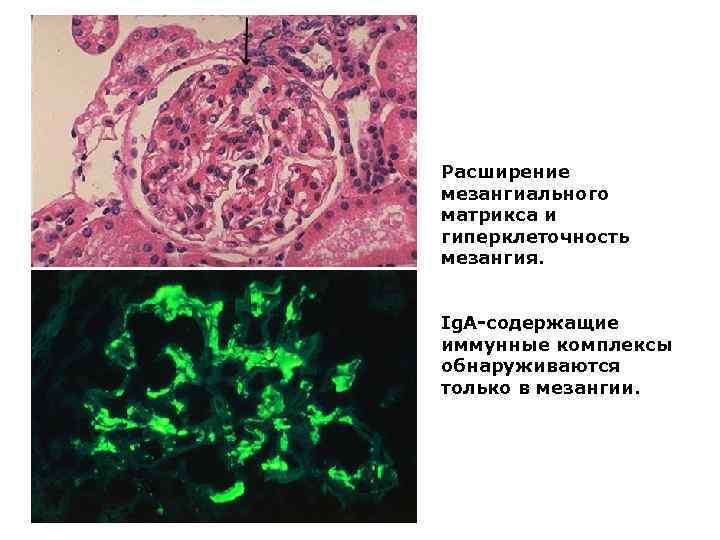 Расширение мезангиального матрикса и гиперклеточность мезангия.  Ig. A-содержащие иммунные комплексы обнаруживаются только в