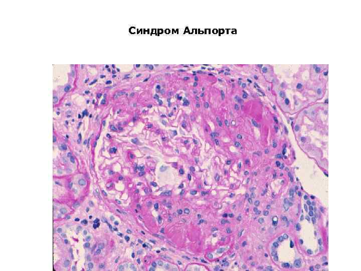 Синдром Альпорта 