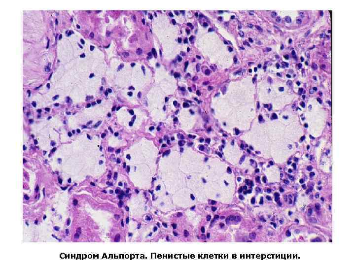 Синдром Альпорта. Пенистые клетки в интерстиции. 