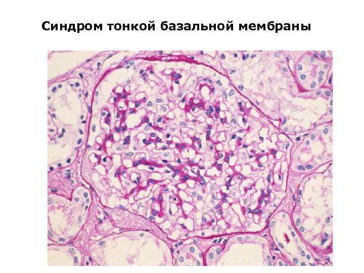 Синдром тонкой базальной мембраны 