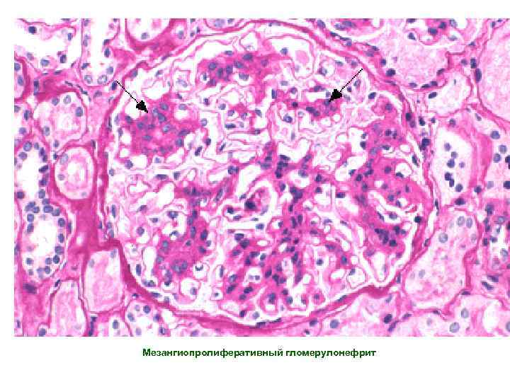 Мезангиопролиферативный гломерулонефрит 