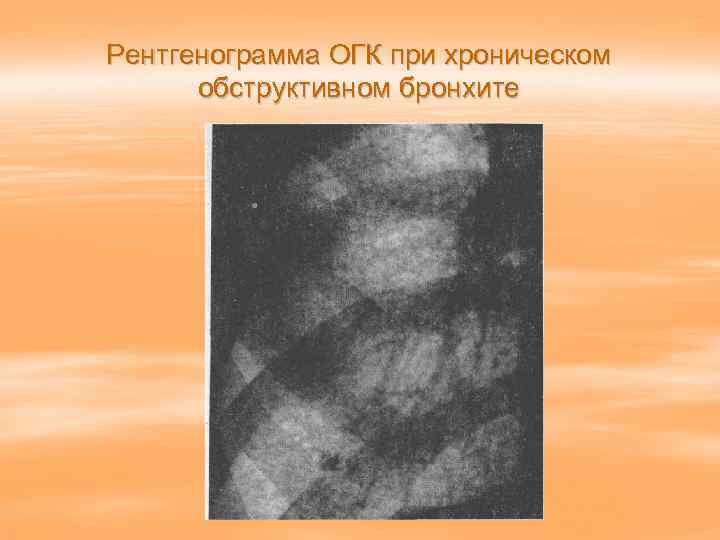 Рентгенограмма ОГК при хроническом  обструктивном бронхите 