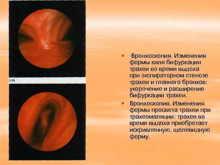 § Бронхоскопия. Изменения  формы киля бифуркации  трахеи во время выдоха  при