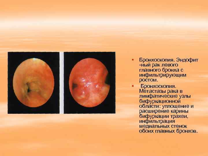 Эндоскопическая картина гпод