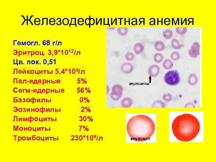 Железодефицитная анемия Гемогл. 68 г/л Эритроц. 3, 9*1012/л Цв. пок. 0, 51 Лейкоциты Железодефицитная анемия Гемогл. 68 г/л Эритроц. 3, 9*1012/л Цв. пок. 0, 51 Лейкоциты