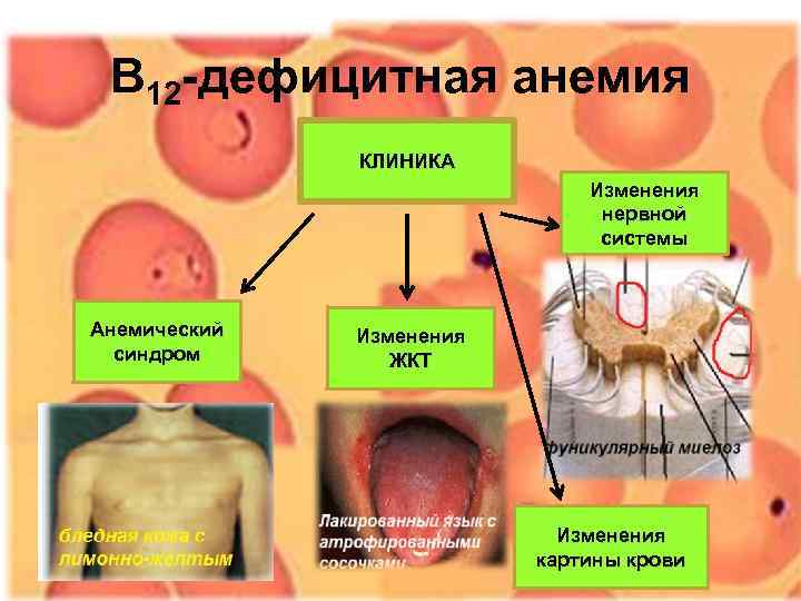 В 12 -дефицитная анемия КЛИНИКА В 12 -дефицитная анемия КЛИНИКА