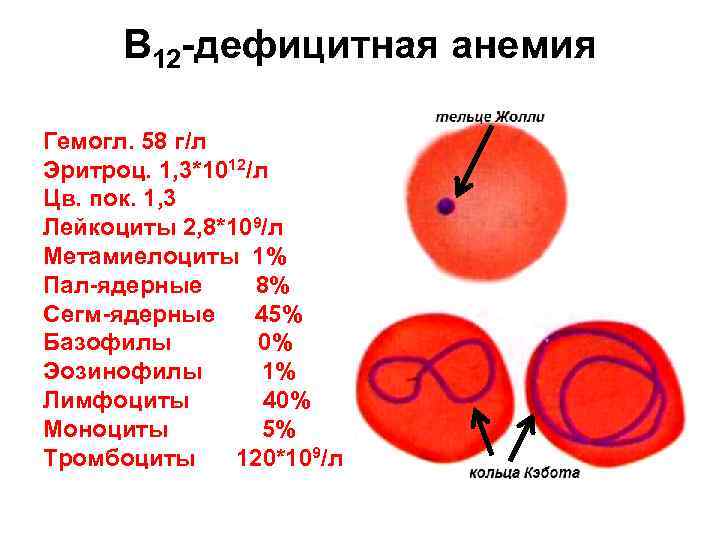 В 12 -дефицитная анемия Гемогл. 58 г/л Эритроц. 1, 3*1012/л Цв. пок. 1, В 12 -дефицитная анемия Гемогл. 58 г/л Эритроц. 1, 3*1012/л Цв. пок. 1,