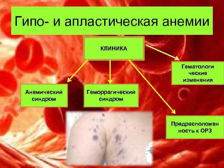 Гипо- и апластическая анемии КЛИНИКА Гематологи Гипо- и апластическая анемии КЛИНИКА Гематологи