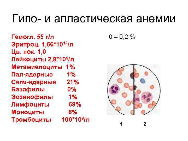 Гипо- и апластическая анемии Гемогл. 55 г/л 0 – 0, 2 % Гипо- и апластическая анемии Гемогл. 55 г/л 0 – 0, 2 %
