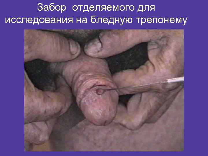 Забор отделяемого для исследования на бледную трепонему 