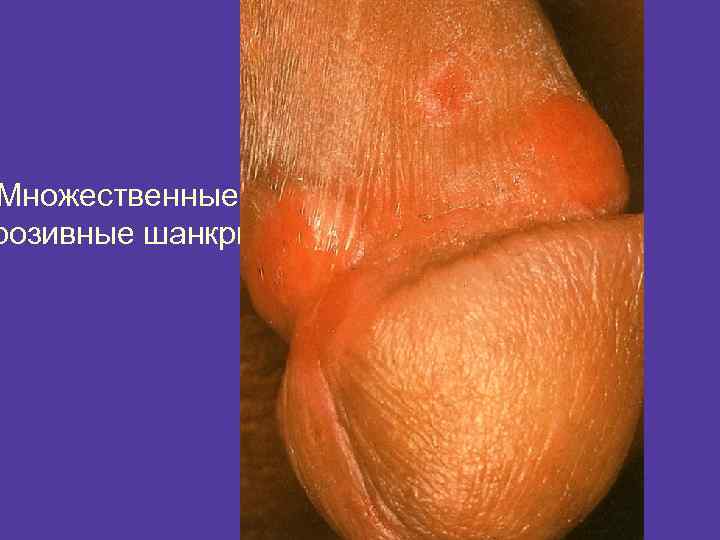 Множественные розивные шанкры 