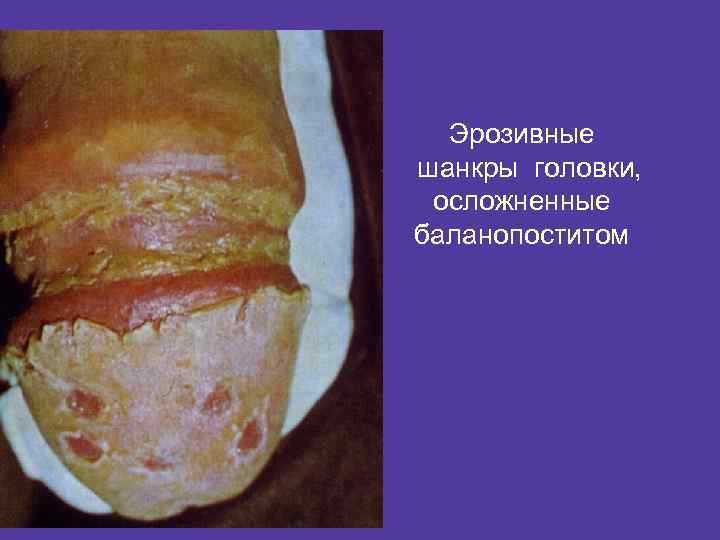 Эрозивные шанкры головки, осложненные баланопоститом 