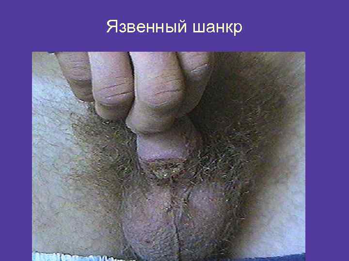 Язвенный шанкр 