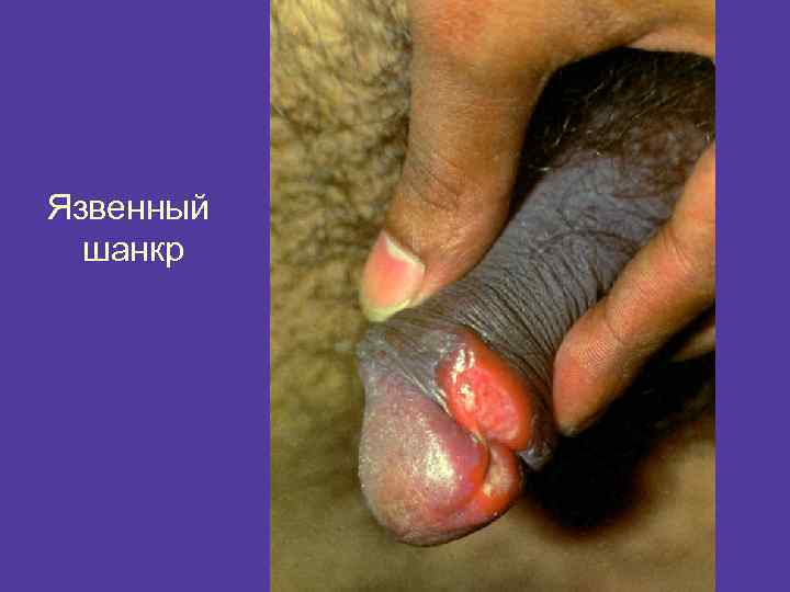 Язвенный шанкр 