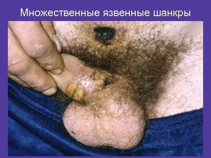 Множественные язвенные шанкры 