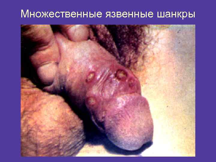 Множественные язвенные шанкры 