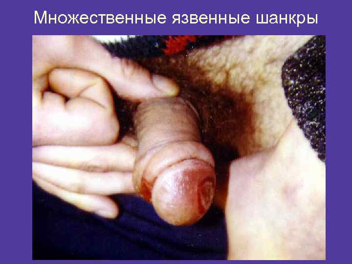 Множественные язвенные шанкры 