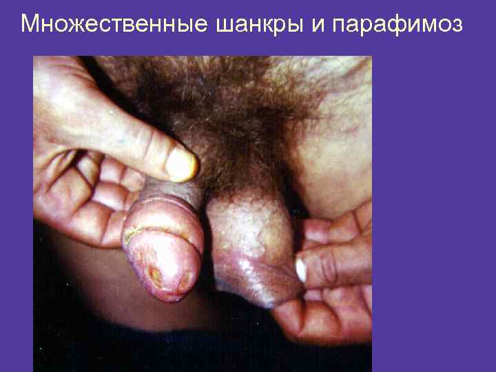 Множественные шанкры и парафимоз 