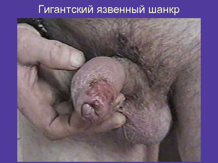Гигантский язвенный шанкр 