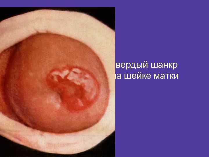 Твердый шанкр на шейке матки 