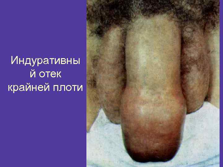 Индуративны й отек крайней плоти 