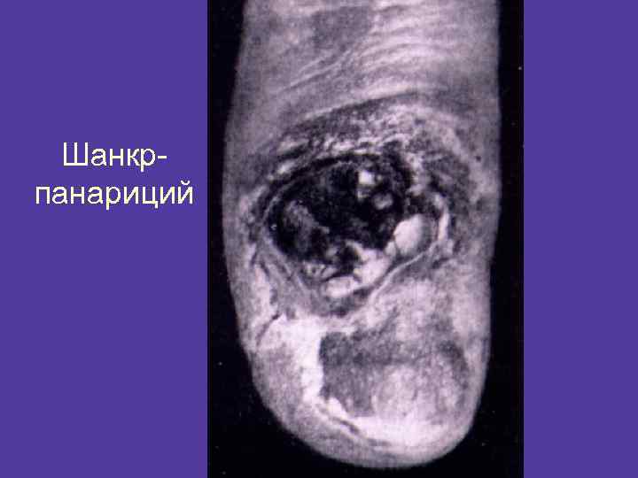 Шанкрпанариций 
