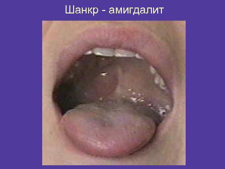 Шанкр - амигдалит 