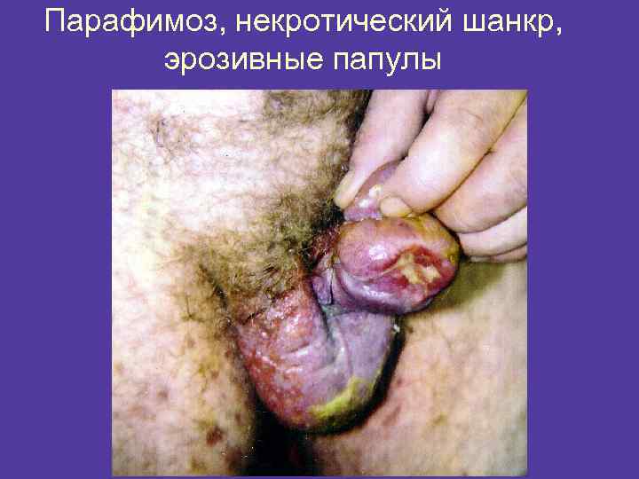 Парафимоз, некротический шанкр, эрозивные папулы 