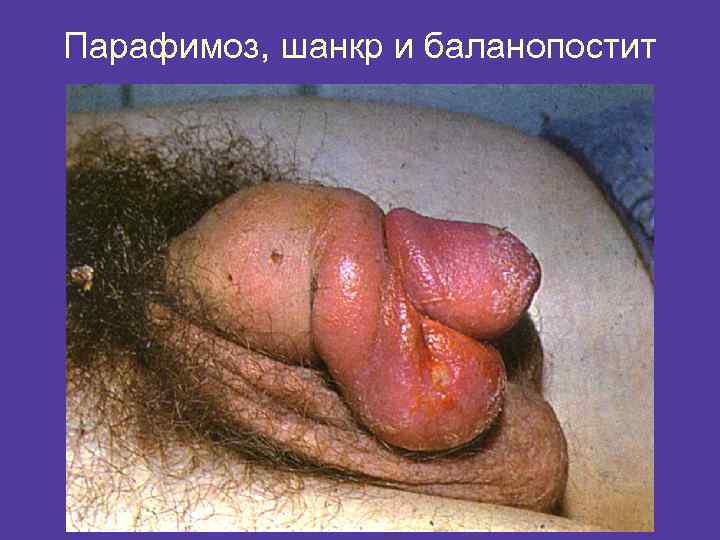 Парафимоз, шанкр и баланопостит 