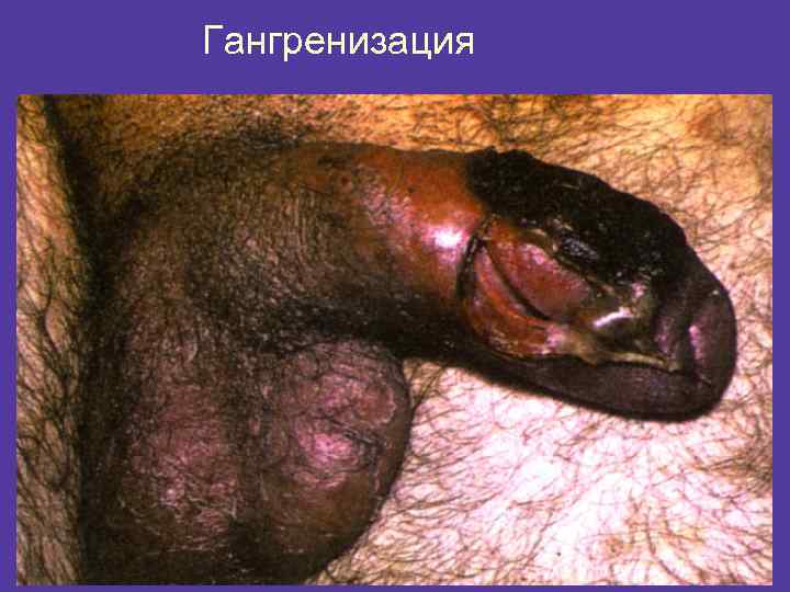 Гангренизация 