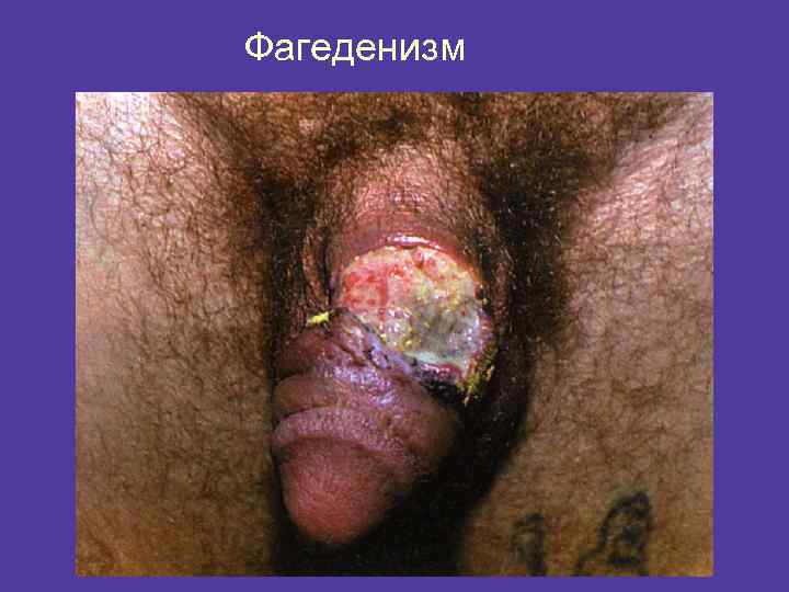 Фагеденизм 