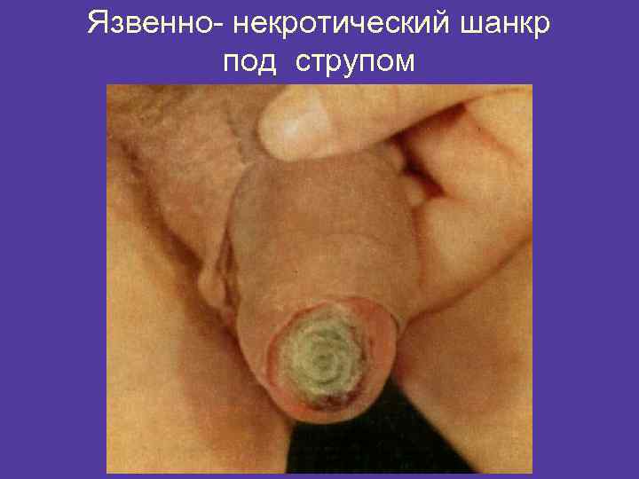Язвенно- некротический шанкр под струпом 