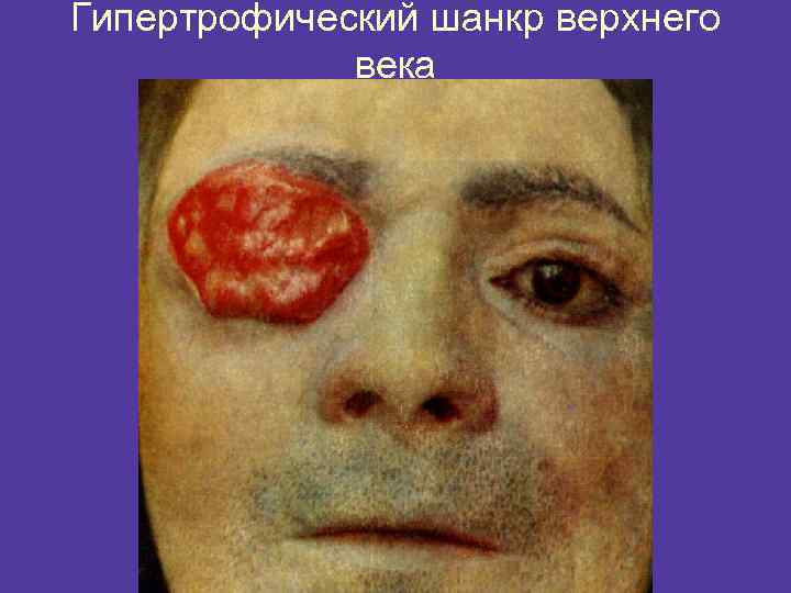 Гипертрофический шанкр верхнего века 