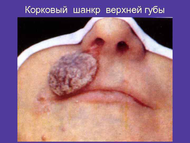 Корковый шанкр верхней губы 