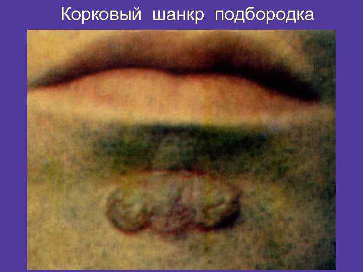 Корковый шанкр подбородка 
