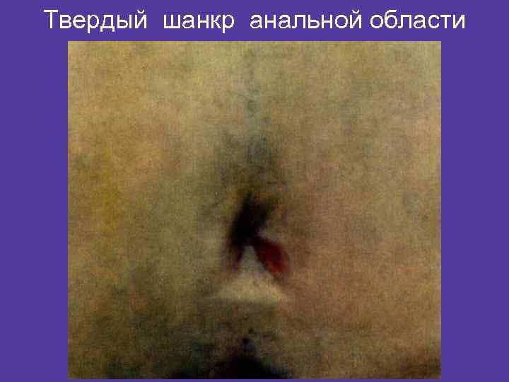 Твердый шанкр анальной области 