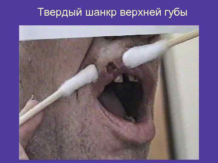 Твердый шанкр верхней губы 