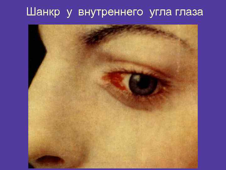 Шанкр у внутреннего угла глаза 