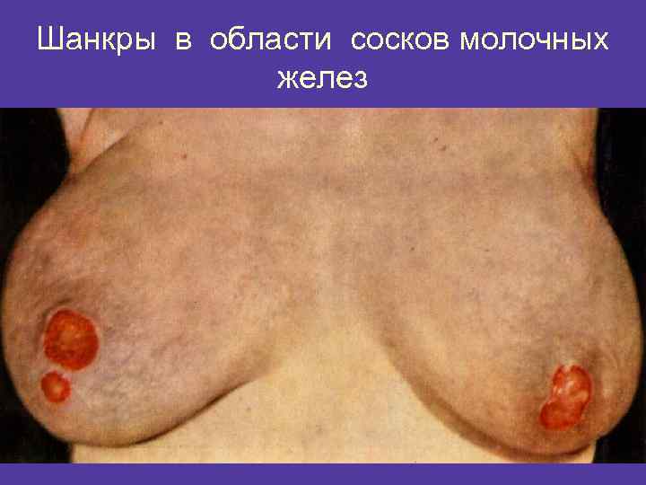 Шанкры в области сосков молочных желез 