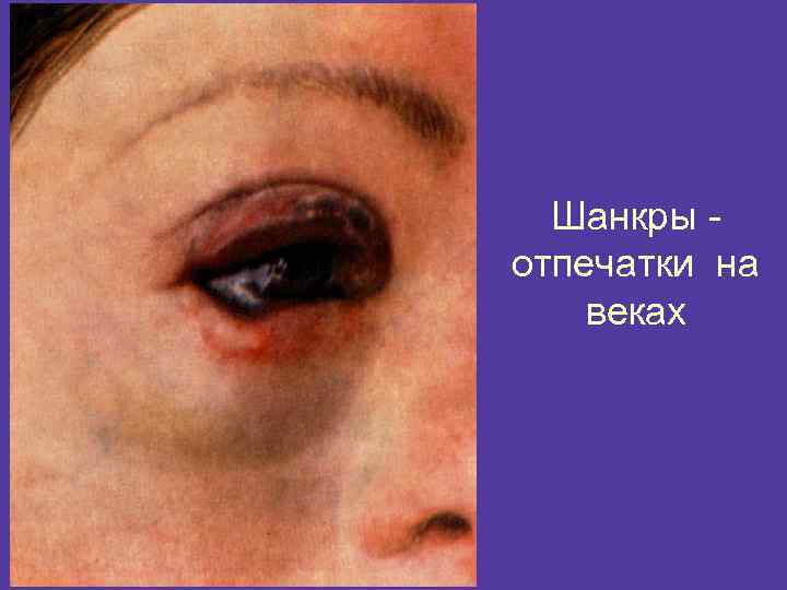 Шанкры отпечатки на веках 