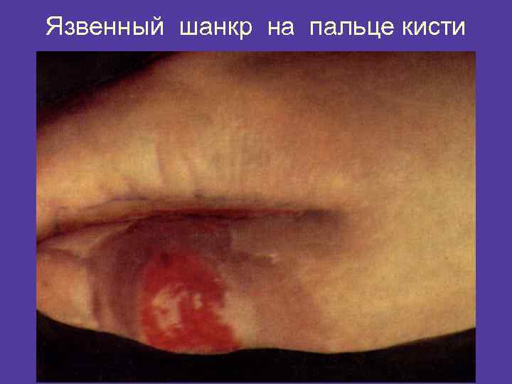 Язвенный шанкр на пальце кисти 