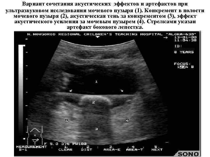 Узи мочевого пузыря подготовка. Акустическое усиление на УЗИ. Акустическое окно при УЗИ. Артефакты при УЗИ. Острый цистит на УЗИ мочевого пузыря.