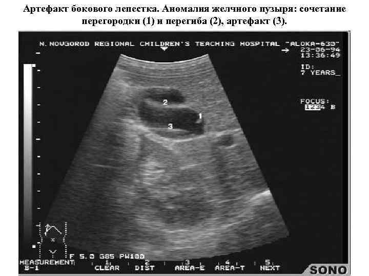 Артефакт бокового лепестка. Аномалия желчного пузыря: сочетание  перегородки (1) и перегиба (2), артефакт
