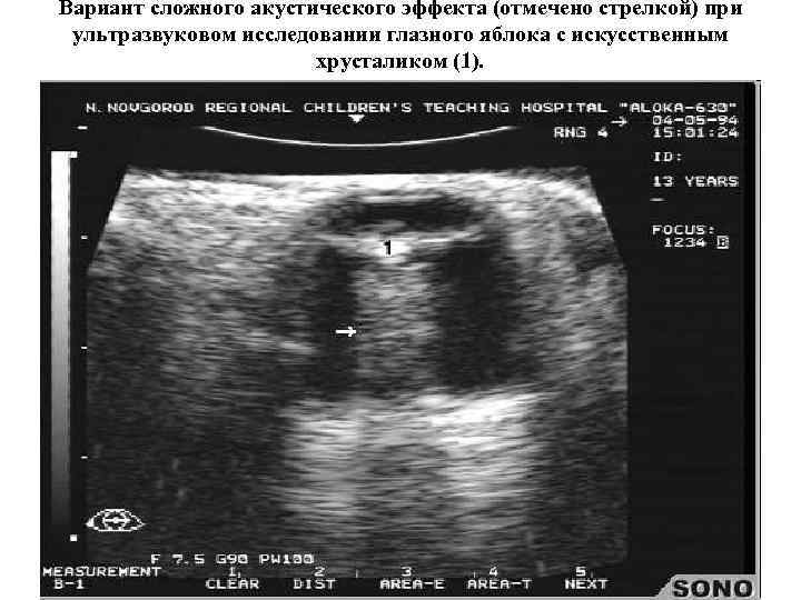 Вариант сложного акустического эффекта (отмечено стрелкой) при ультразвуковом исследовании глазного яблока с искусственным 