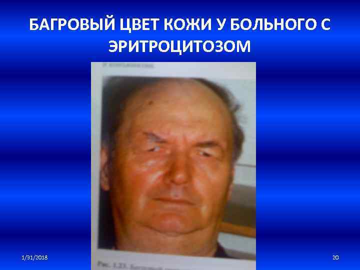 БАГРОВЫЙ ЦВЕТ КОЖИ У БОЛЬНОГО С ЭРИТРОЦИТОЗОМ 1/31/2018 20 