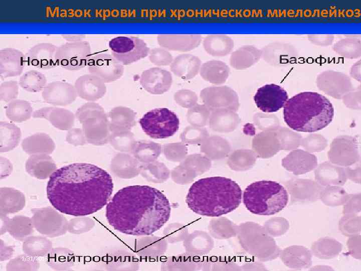 Картина крови и костного мозга при хроническом миелолейкозе истинной полицитемии