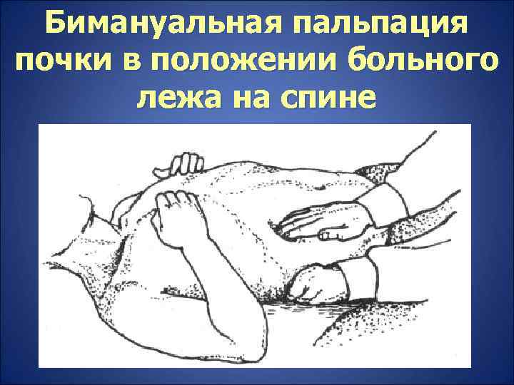  Бимануальная пальпация почки в положении больного  лежа на спине 