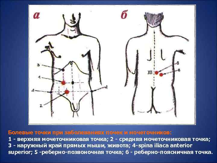 Болевые точки при заболеваниях почек и мочеточников: 1 - верхняя мочеточниковая точка; 2 -