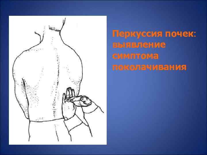 Перкуссия почек: выявление симптома поколачивания 