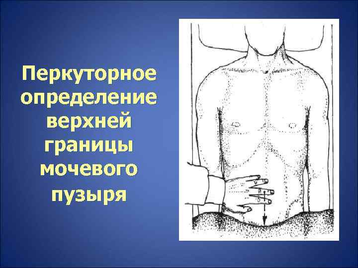 Перкуторное определение  верхней  границы  мочевого  пузыря 